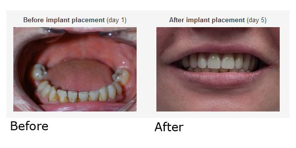 Dental Implant Restoration 